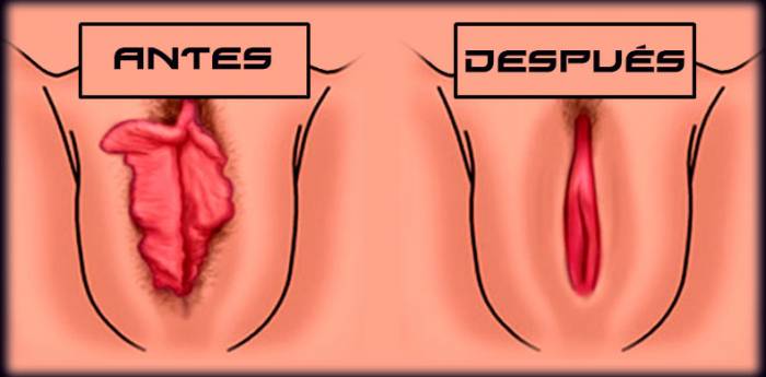 vaginoplastia_web